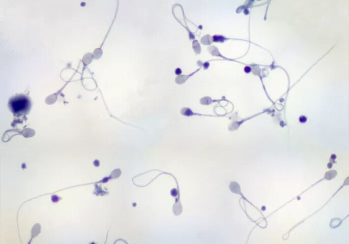 Diagnosed oligozoospermia - few spermatozoa